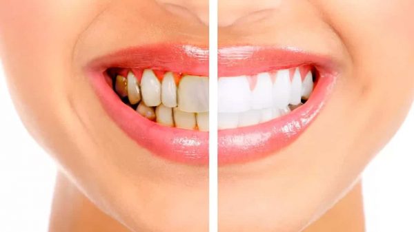 Diş Taşı Temizliği Detertraj Nedir